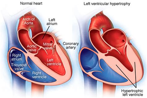 severe ventricular hypertrophy symptoms